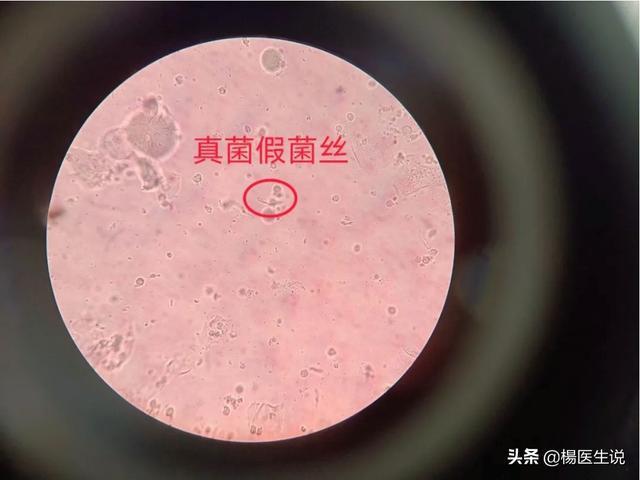 真实病例滴虫合并霉菌性阴道炎实属少见