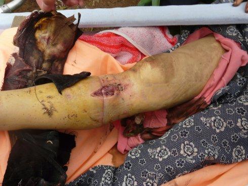 图片说明:在处理伤员中,其中一位老人的伤口因严重感染,长出了许多