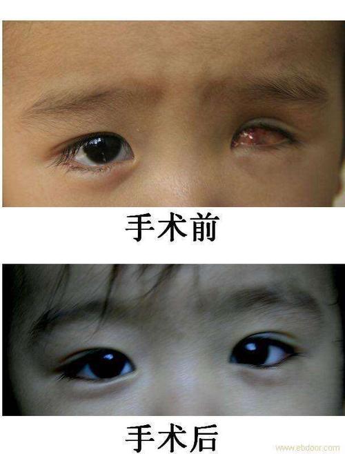 义眼适合什么样的患者?