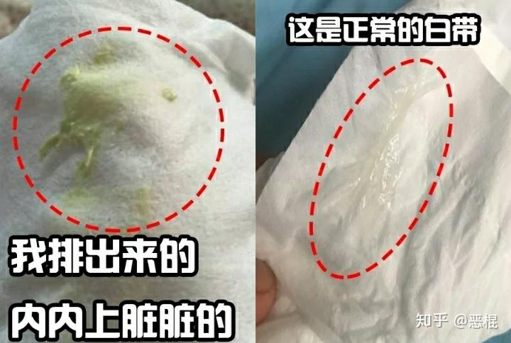 成都医院阴道炎妇科炎症治疗经历