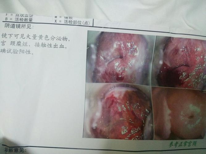 周一去医院做了检查,查出来宫颈糜烂重度. 医生劝我做
