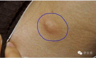 1,乳房的外表出现变化,乳腺皮肤出现粗糙像桔子皮样的改变,或者乳房