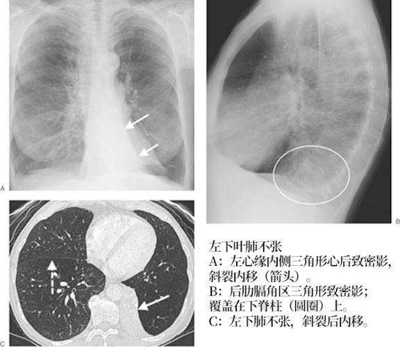 肺不张:影像基本思路
