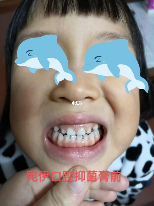 孩子牙齿07上的黑斑,不可小觑 宝爸宝妈们万不可掉以轻心 早发现,早