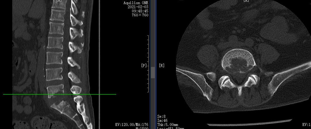 ct提示患者腰5骶1椎间隙有骨质破坏,顾宇彤教授认为该患者为腰骶椎