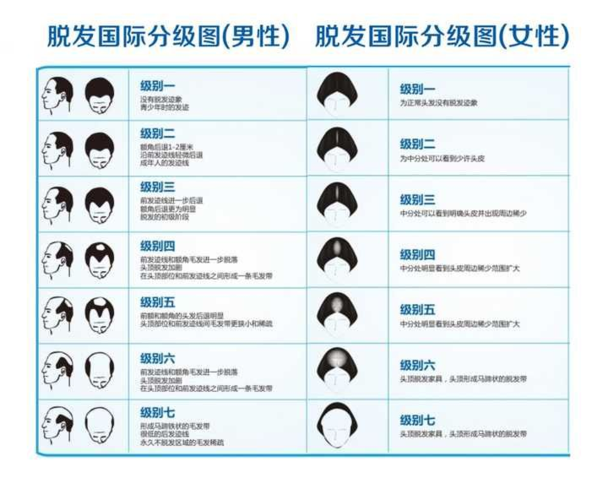 这个发际线算不算高啊?