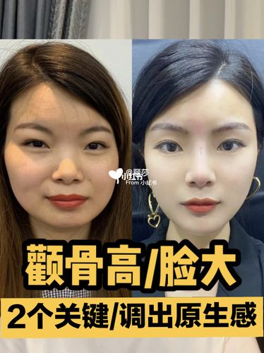 颧骨颧弓骨高太阳穴凹脸大怎么do