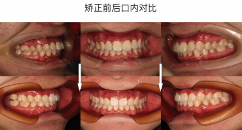 牙齿整齐还不够,嘴突男孩矫正后变帅气型男