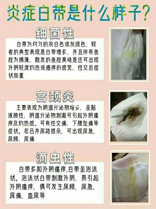 你的白带颜色正常吗?告别妇科炎症趁现在! 我这也是第