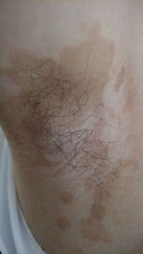 问:腋下长了这样的斑,去年开始长的,一直没怎么在意,今年斑越来越多