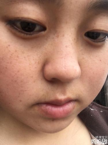 看看这脸斑?吓到你们没?