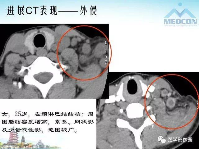 颈部淋巴结结核msct表现及鉴别 | 影像天地