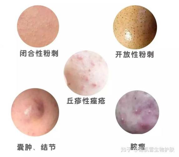微小粉刺→闭合性粉刺→开放性粉刺→丘疹性痤疮→脓疱→囊肿结节