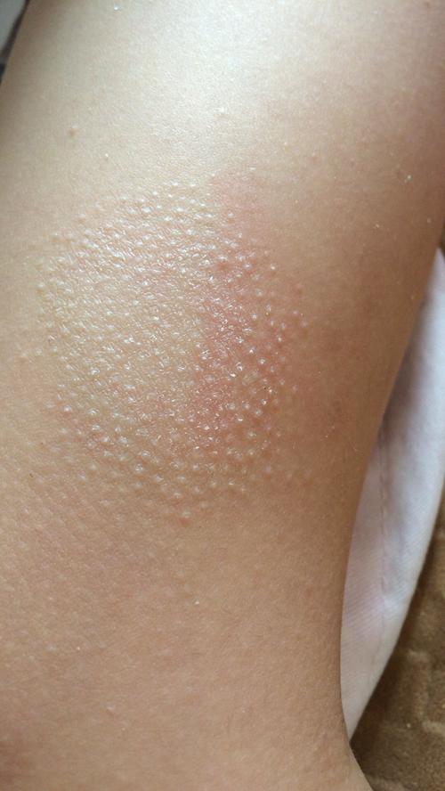 2016-05-02 17:58    浏览  33333  满意回答 毛周角化症造成的