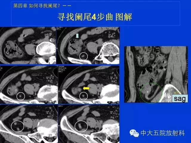 【经典之作】正常阑尾和阑尾炎的ct表现