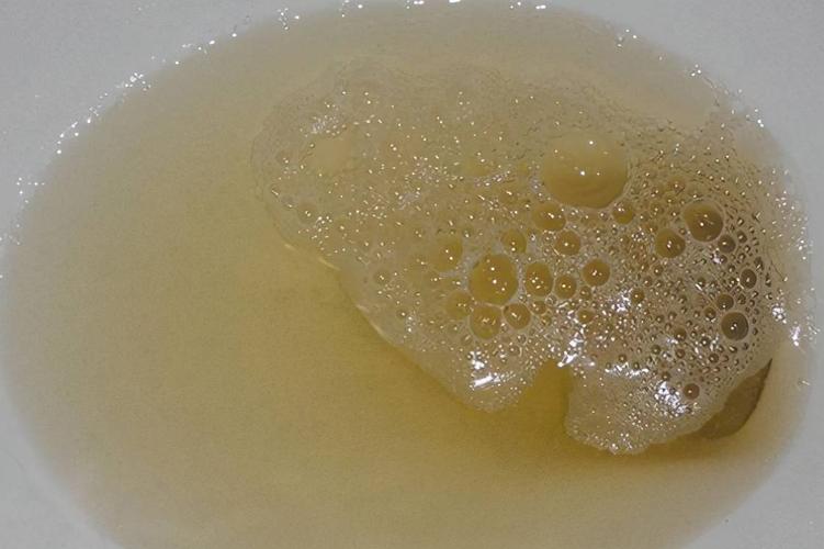 早上起床后观察一下"第一次排尿",若有3种情况,或是尿酸高了