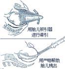 1产钳分娩编辑 迎接分娩图 产钳分娩:是难产时为了让宝宝不至于陷入