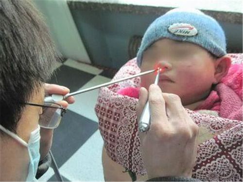 笔帽掉进耳朵里,8年之后才取出来,女孩:当作成长纪念永远珍藏