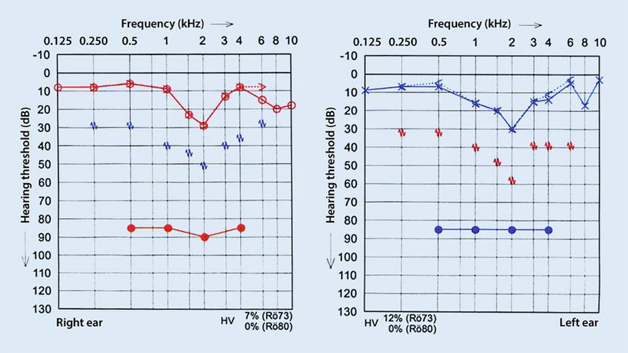 纯音测听显示在2khz双侧对称听力下降(见图1).