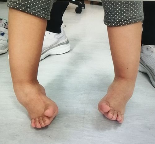 先天性马蹄内翻足