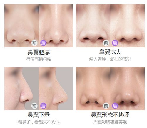 鼻翼缘应该是我们的线条协调的弧线,其不能过高,过低,过直或不对称.