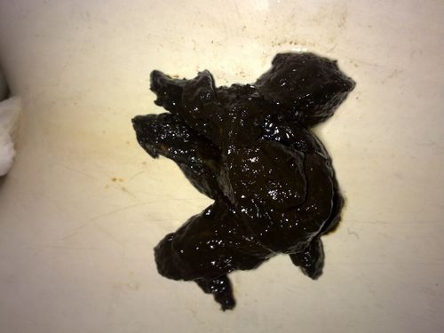 养生之道 大便发黑是什么原因  正常大便的颜色是黄色或者是褐色,但是