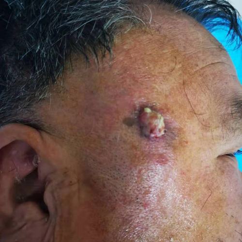 皮肤溃疡反复不愈,小心皮肤癌!