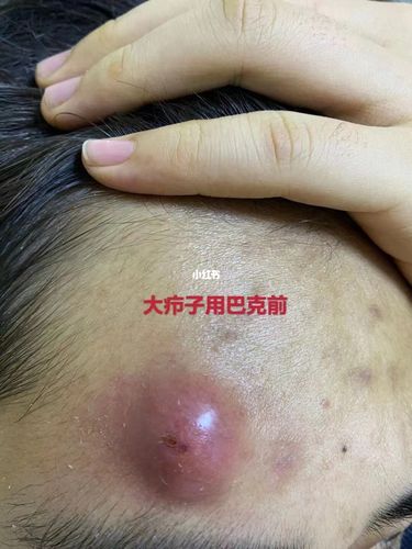 火疖子怎么办居家小妙招_火疖子_医疗健康_医疗健康