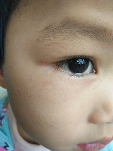 宝宝三岁,发烧后脸上局部红点,宝宝不痛不痒,以前有出