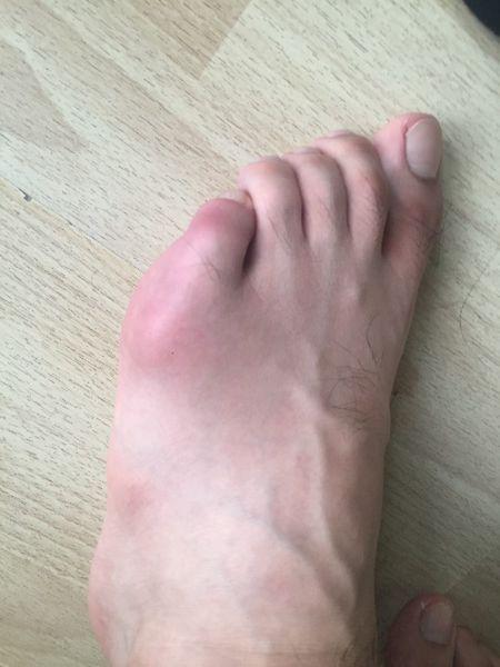 今年22岁,左脚小脚趾关节外侧肿胀半年多了,时好时坏一直疼痛,排除