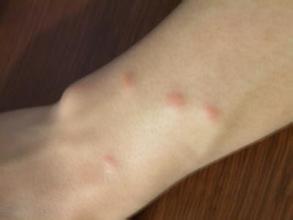 艾滋病的潜伏期和窗口期 艾滋病的临床表现有哪些症状