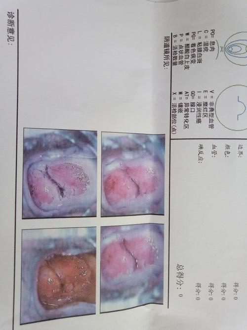 单纯的宫颈糜烂三度,已经用药三个月,每月用9天,前几天复查,是到2度多