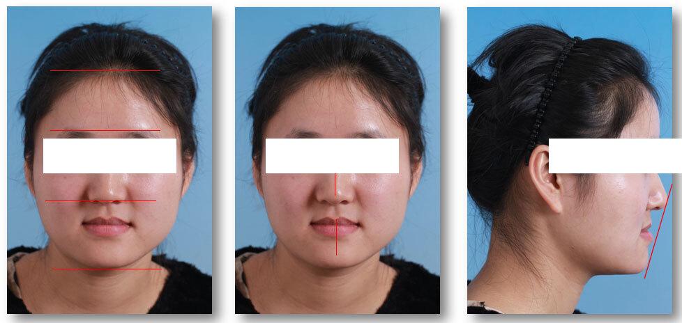 我们能看到她面下1/3略短,下巴靠前,上颌后缩,侧面是非常典型的凹面型