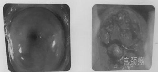 宫颈囊肿,一般简称"纳囊",是宫颈炎的一种.