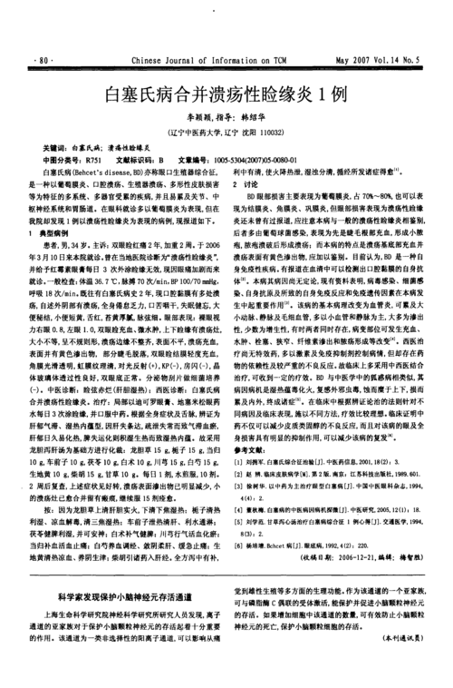 白塞氏病合并溃疡性睑缘炎1例