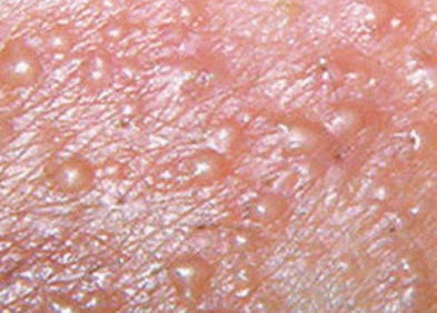 女性假性湿疣的治疗办法 如何预防假性湿疣