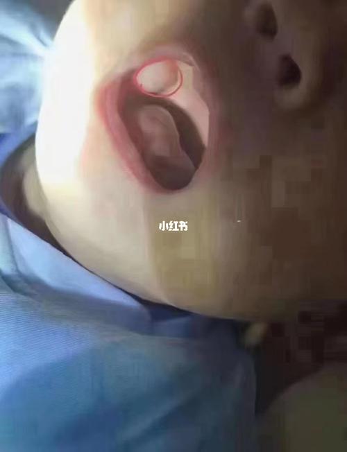 宝宝口腔内的脂肪垫,属于正常现象,有利于孩子吸吮的,无需处理哟95