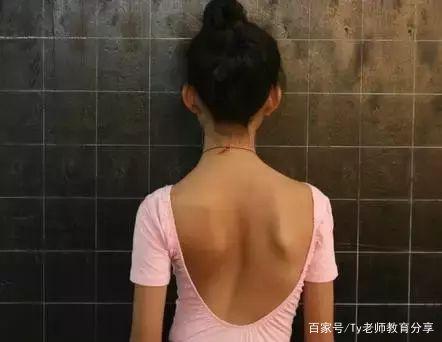 含胸(圆肩),驼背(胸椎曲度增加),肩胛骨耸起,斜肩等一系列形体的变化