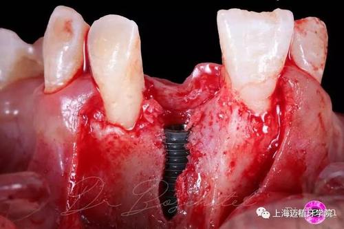 植入美格真植体