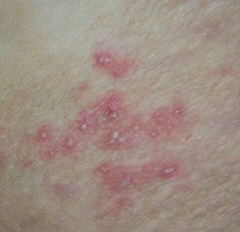 2014-06-01 马金峰 医师 这是哪种皮肤病?到底是藓?湿疹?