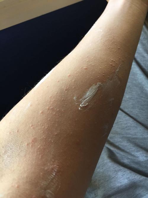 请问出现这些红点是过敏吗