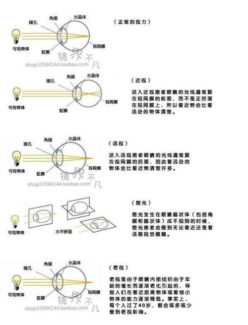 眼睛屈光示意图