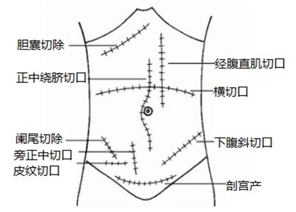 疝气百科为什么会得小肠气