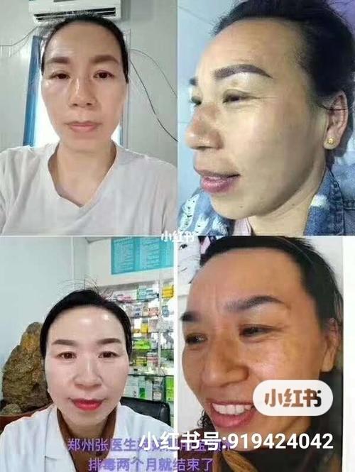 宝颜术排毒,自己个朋友排毒中的照片_排毒_美妆_护肤