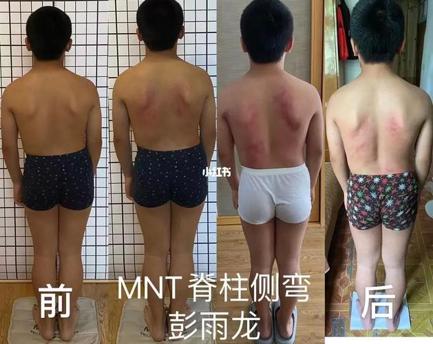 青少年脊柱侧弯案例_佛山市自由行热门攻略_脊柱侧弯