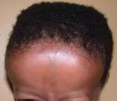 医学上描述的方颅主要在前额那一块.