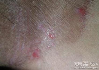 睾丸潮湿怎么办