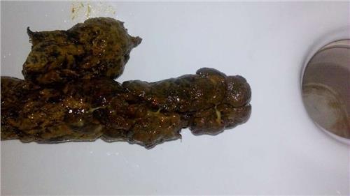 大便有白色粘液的原因