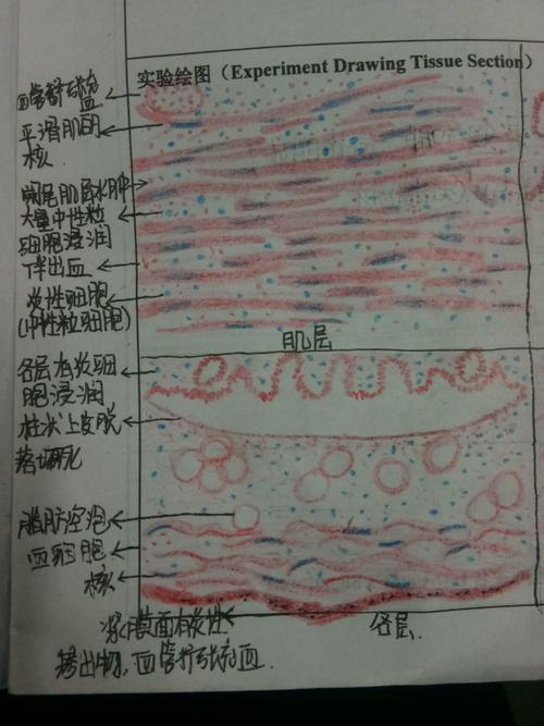 求一张化脓性阑尾炎手绘图,结构清晰?