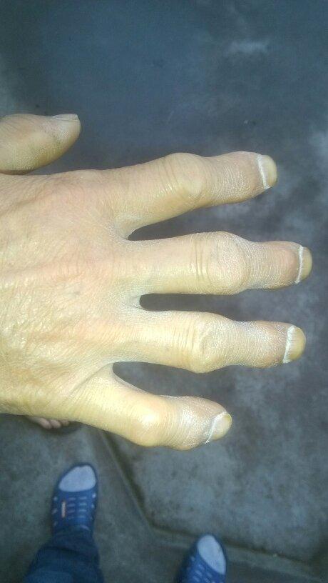 请教,手指关节,变形,疼痛,是什么原因.